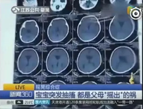 多名婴儿脑出血，，，，，，，家长一个不经意的作为竟然对宝宝中伤这么大1.webp.jpg